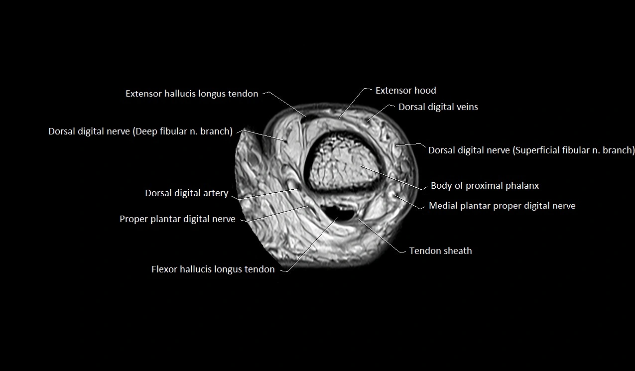 Great toe (hallux) axial microanatomy 3T MRI image 19.webp